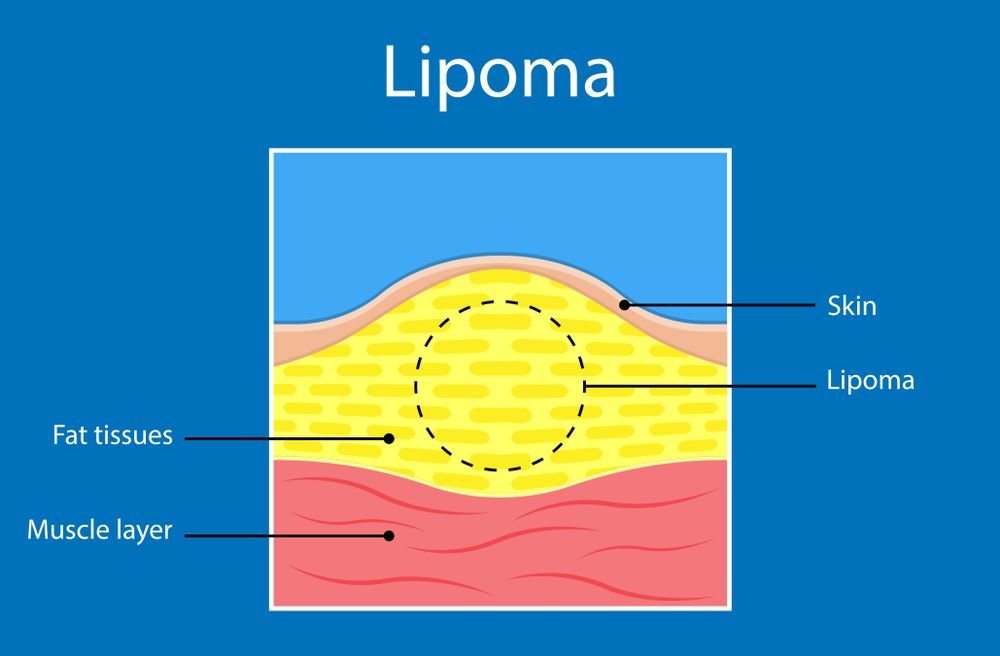Major Symptoms and Causes of lipoma