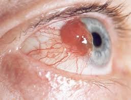causes of eye cancer