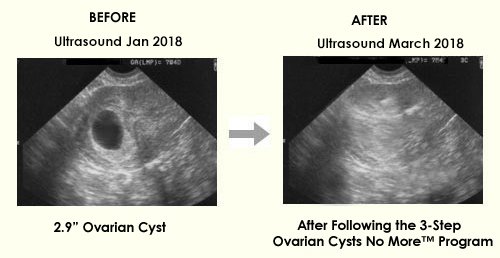 Ovarian Cyst Miracle eBook